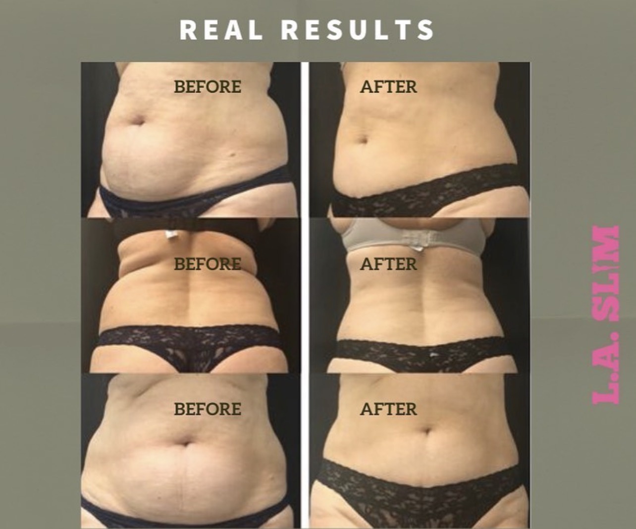 L.A. Slim abdomen contouring result