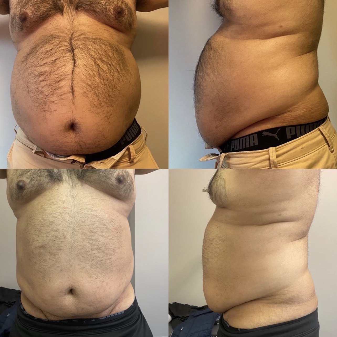 L.A. Slim men's abdomen contouring result