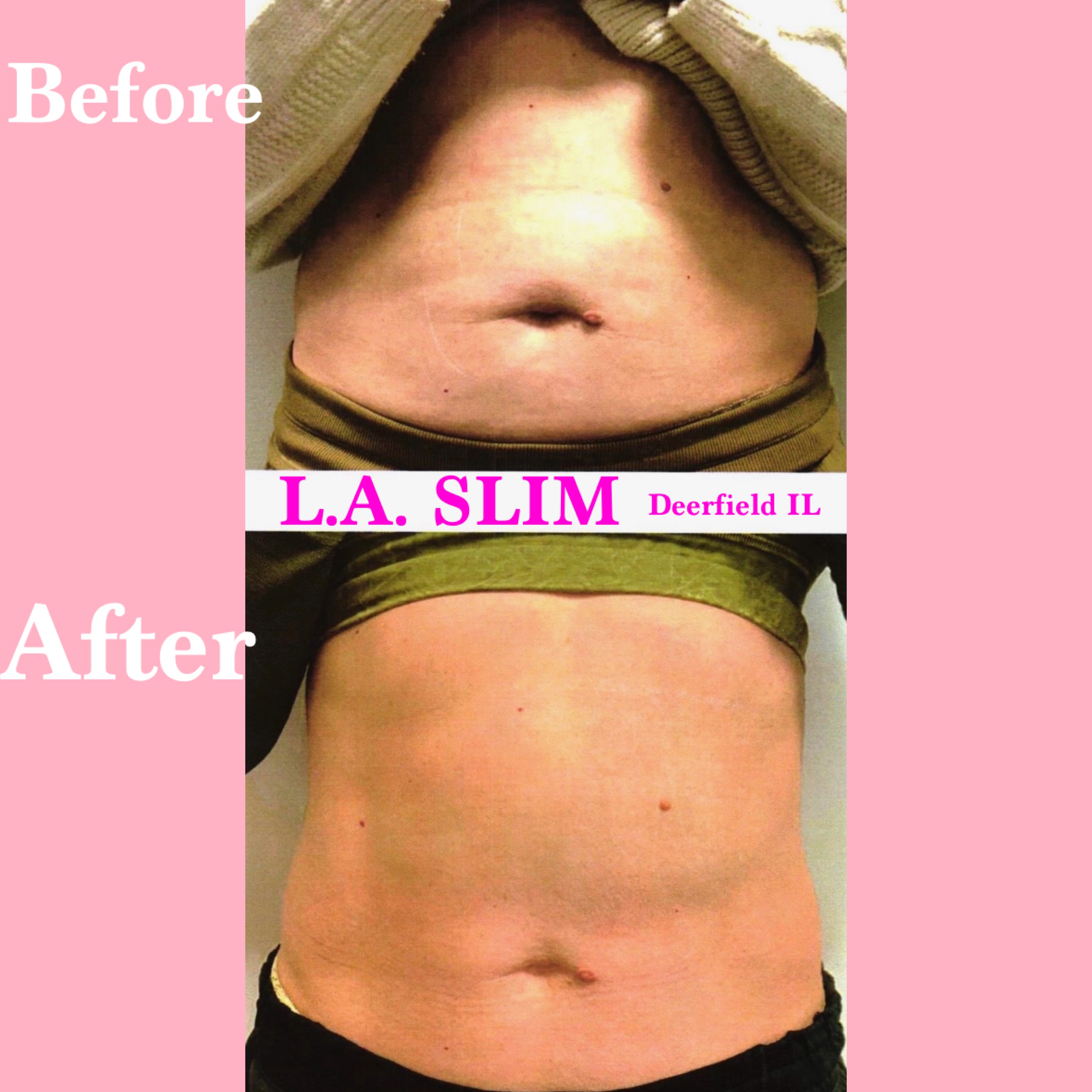 L.A. Slim silhouette contouring transformation