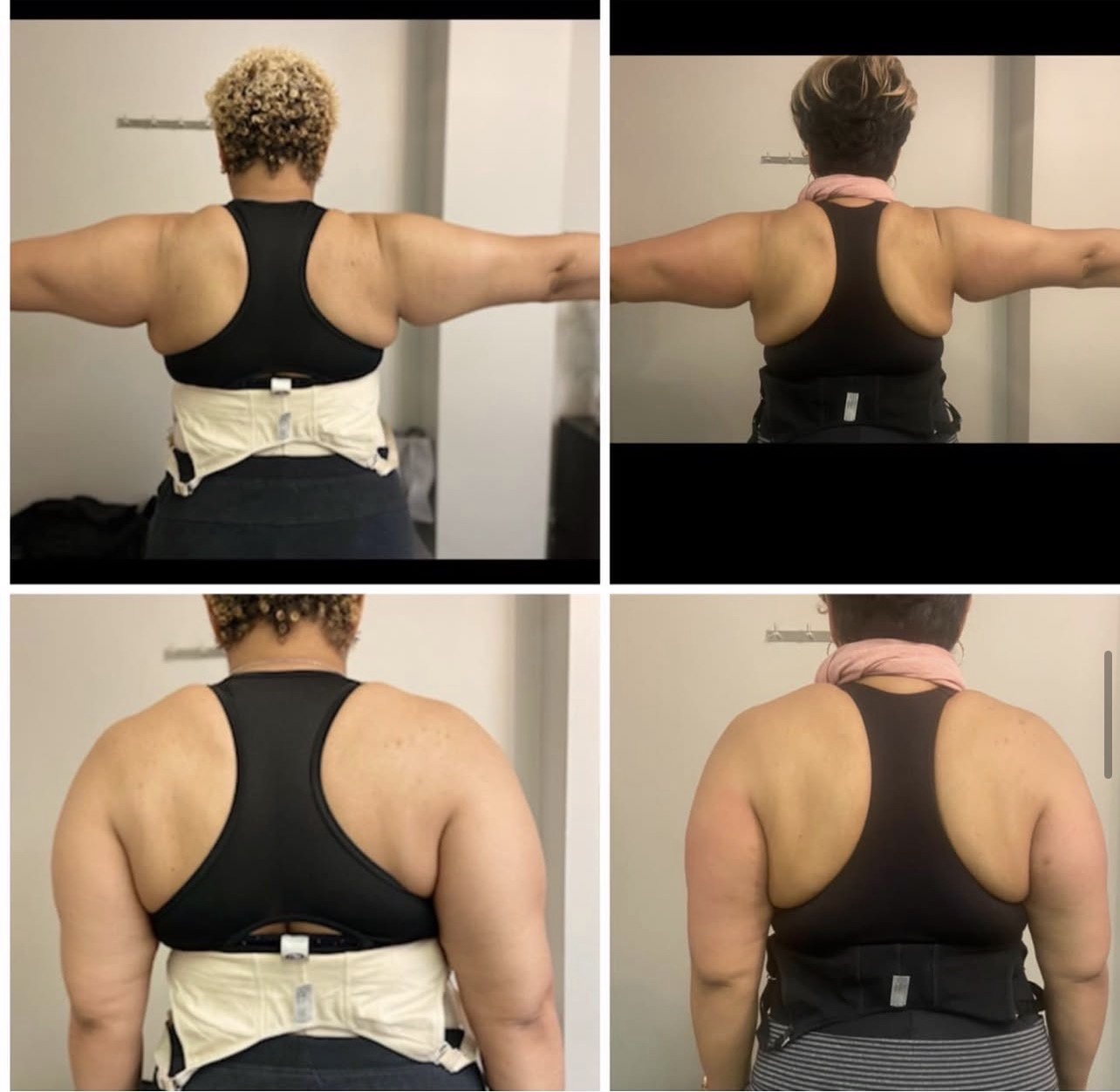 L.A. Slim arm contouring result
