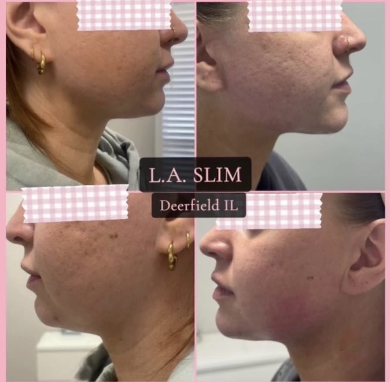 L.A. Slim jawline contouring result
