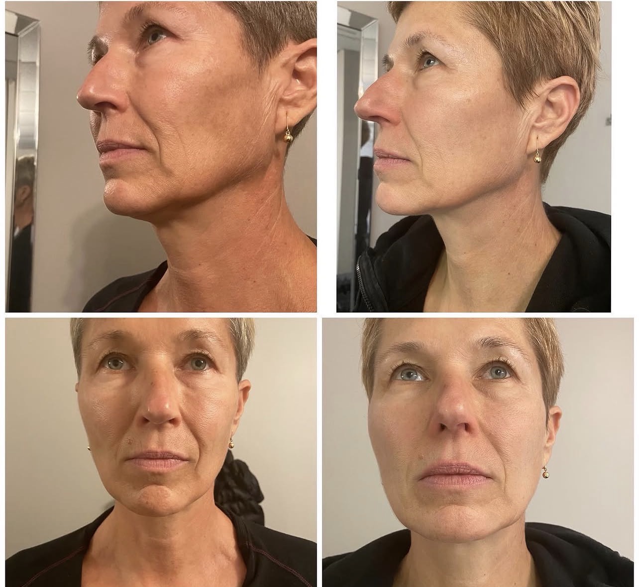 L.A. Slim collagen renewal and fine line treatment result