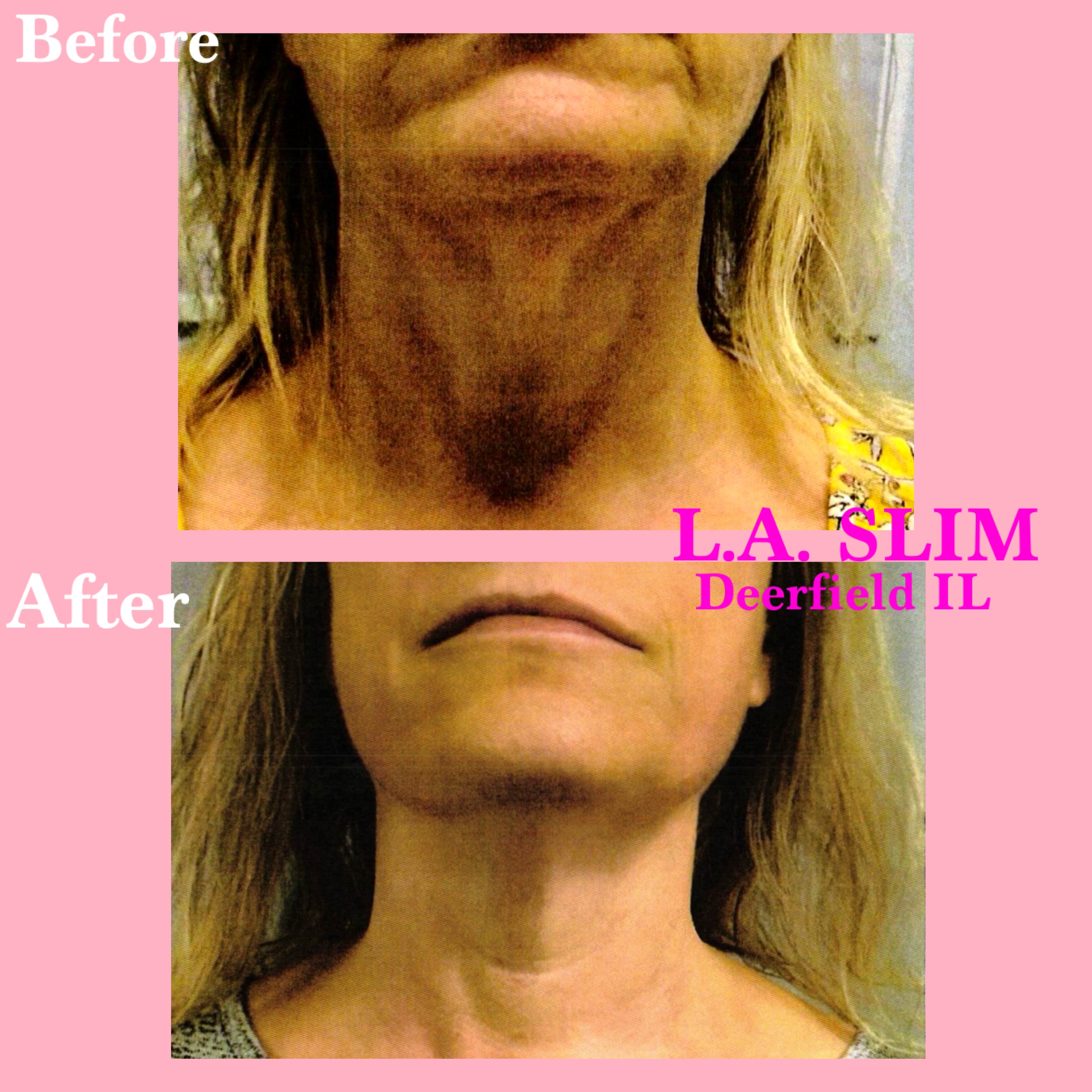 L.A. Slim fine line and wrinkle smoothing result