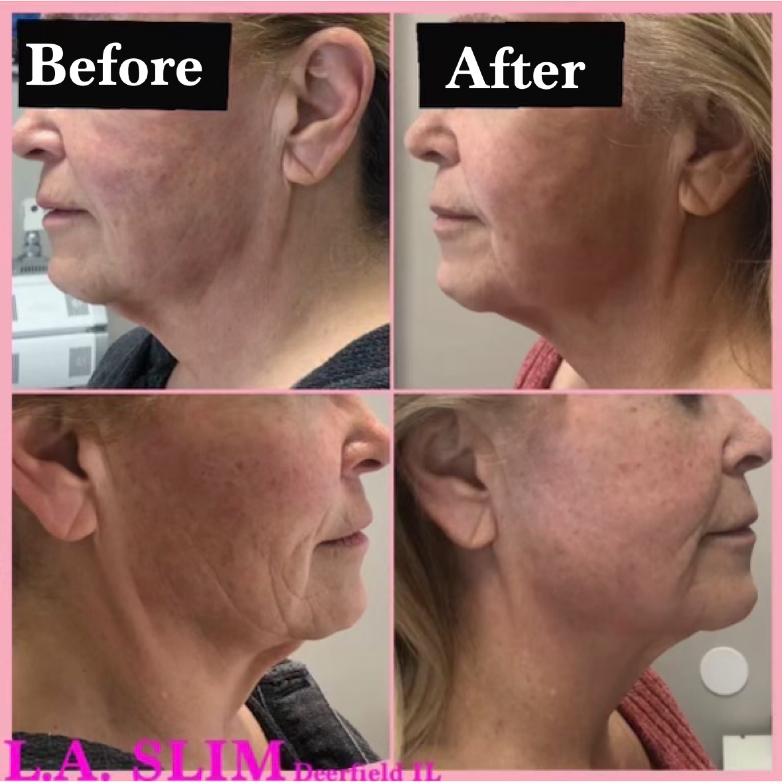 L.A. Slim wrinkle smoothing and skin rejuvenation result