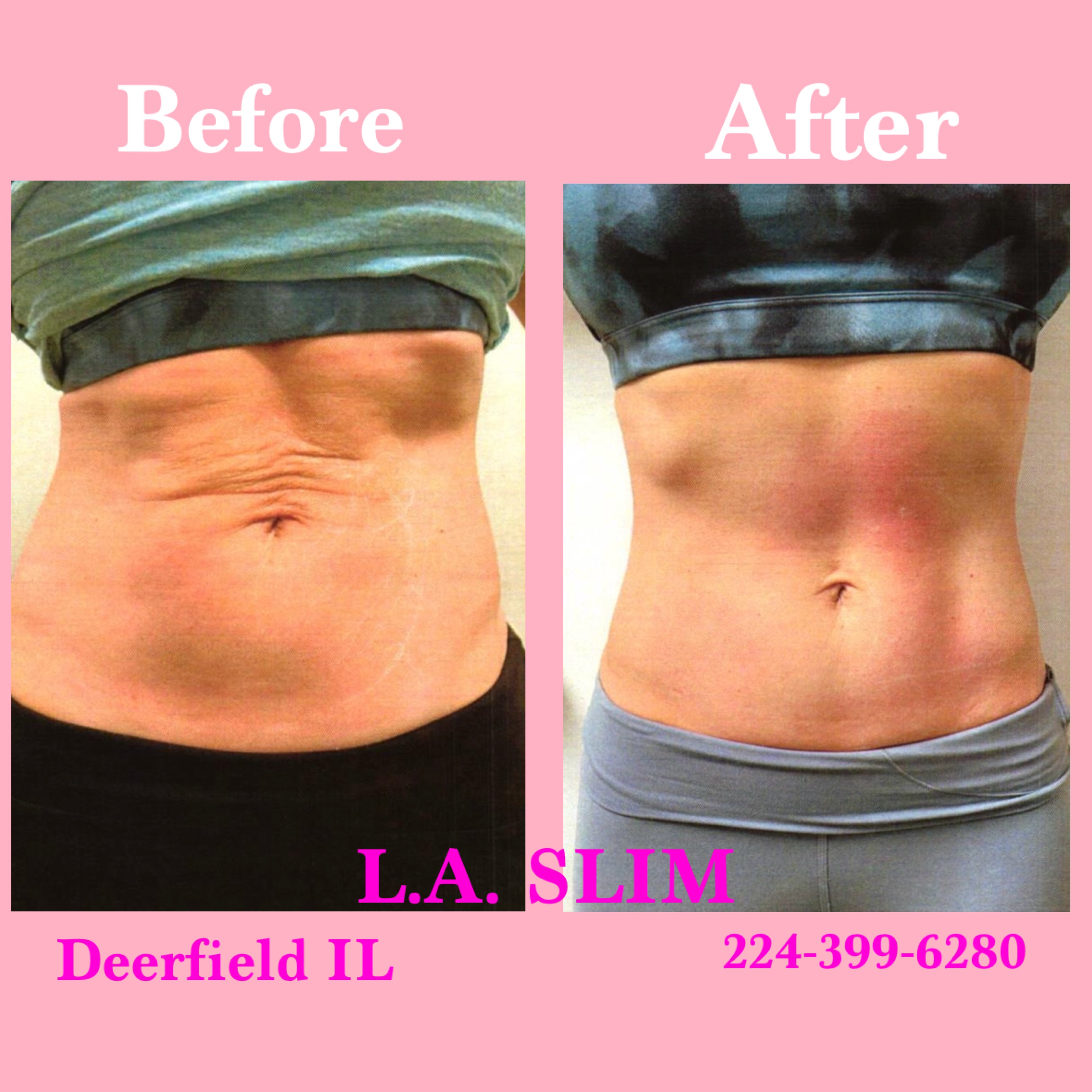L.A. Slim skin smoothing result